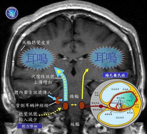 後腦沙沙聲|健康網》耳鳴、腦鳴傻傻分不清 醫教辨別細節